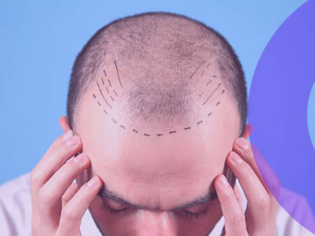 Hair Transplant